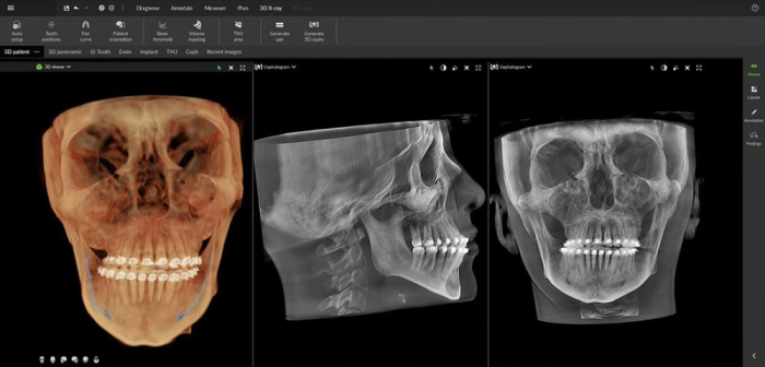 Dexis OP 3D™ LX 12x15 FOV Ceph. Dexis OP 3D™ LX 12x15 FOV Ceph.
