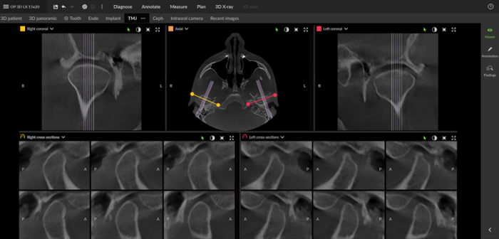 Dexis OP 3D™ LX 12x15 FOV Ceph. Dexis OP 3D™ LX 12x15 FOV Ceph.