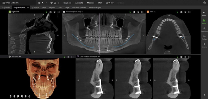 Dexis OP 3D™ LX 10x10 FOV Ceph. Dexis OP 3D™ LX 10x10 FOV Ceph.